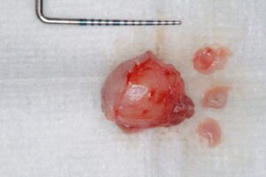 嚢胞本体と小唾液腺