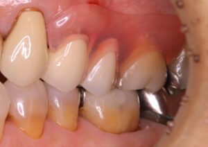 ノンクラスプ義歯