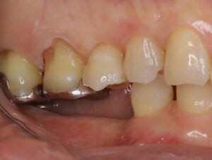 抜歯後に適切な処置を受けずに経過した歯