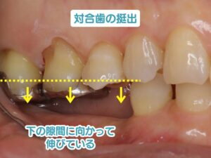 対合歯の挺出