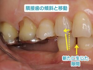 隣接歯の傾斜と移動