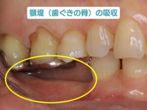 顎堤(歯ぐきの骨)の吸収